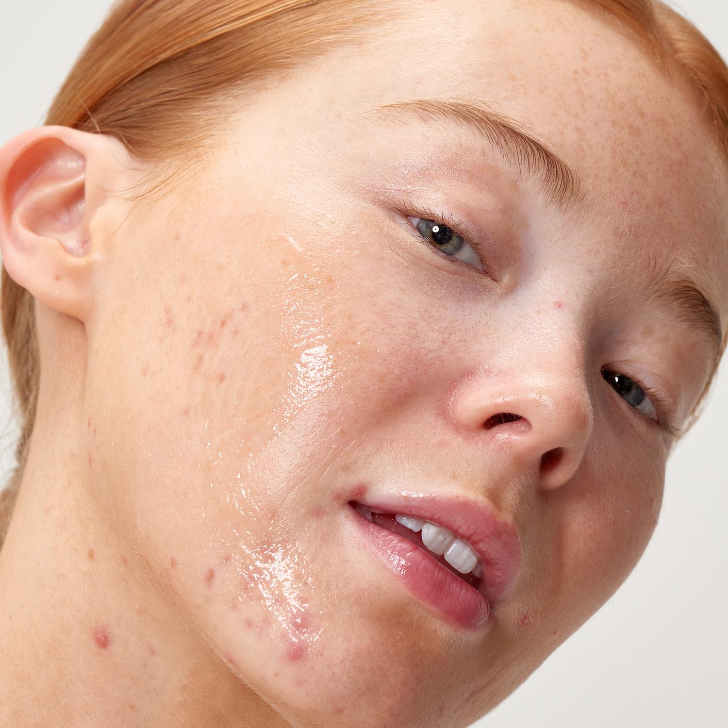 APPLE CIDER VINEGAR ACID PEEL (EXFOLIANTE FACIAL)